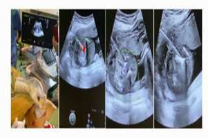 اولین عمل جراحی حذف جنین آکاردیاک (TRAP)  در دوقلوی مونوکوریون همسان  با استفاده از میکرویو 