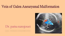 وبینار Vein of galen aneurysmal malformation