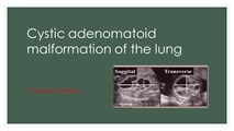 وبینار Cystic adenomatoid malformation of the lung